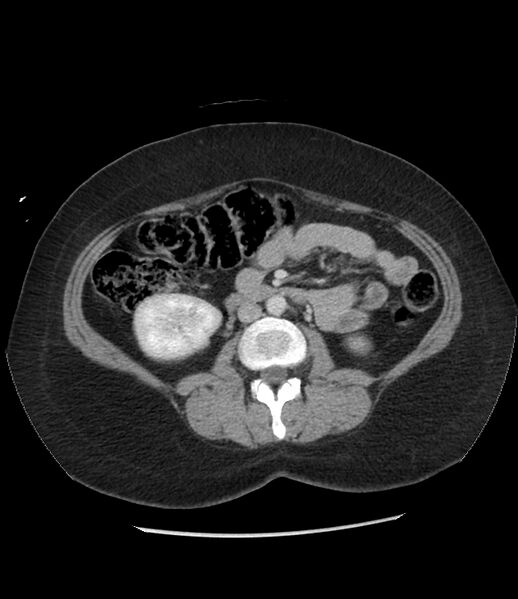 File:Adrenal cortical carcinoma with IVC invasion and thrombosis (Radiopaedia 34307-35597 Axial C+ portal venous phase 45).jpg