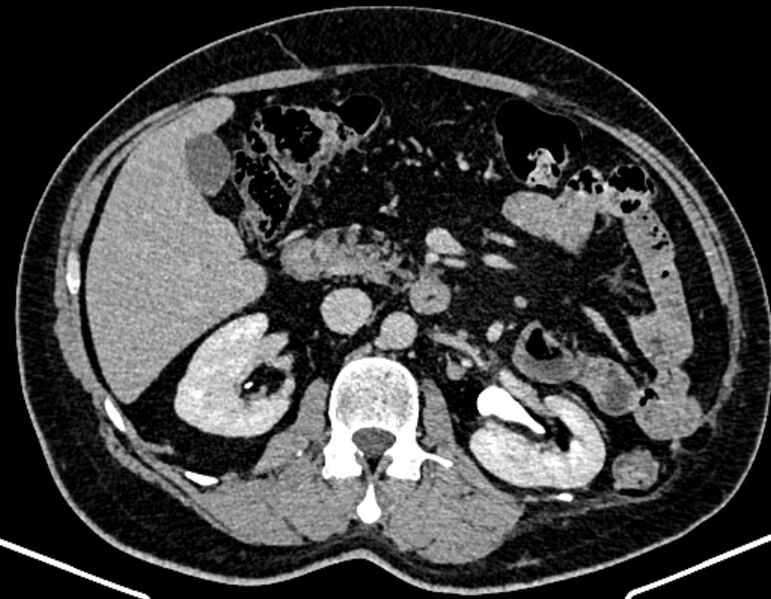 File:Adrenal metastases (Radiopaedia 73082-83791 Axial C+ delayed 140).jpg