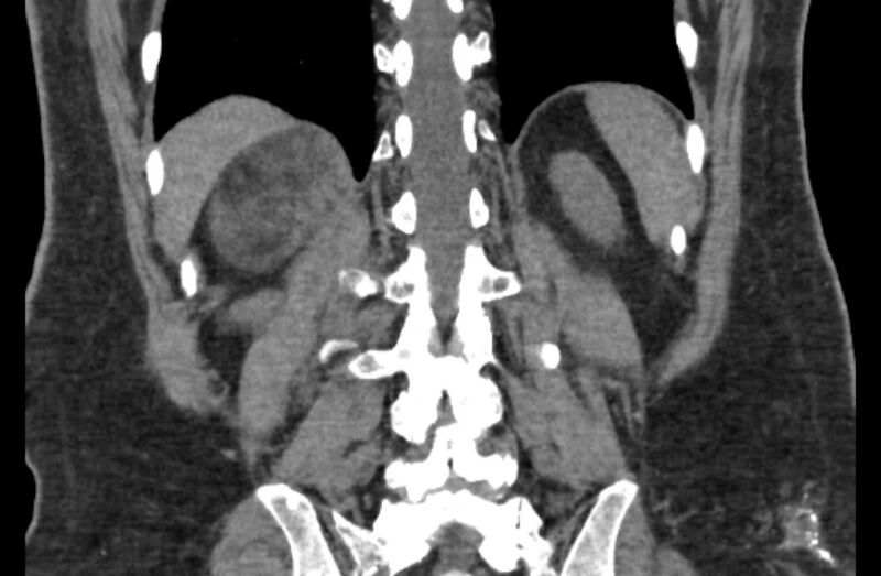 File:Adrenal myelolipoma (Radiopaedia 65240-74253 Coronal non-contrast 57).jpg