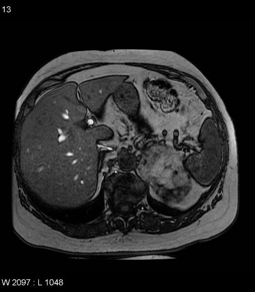File:Adrenal myelolipoma (Radiopaedia 6765-7961 Axial T1 out-of-phase 13).jpg