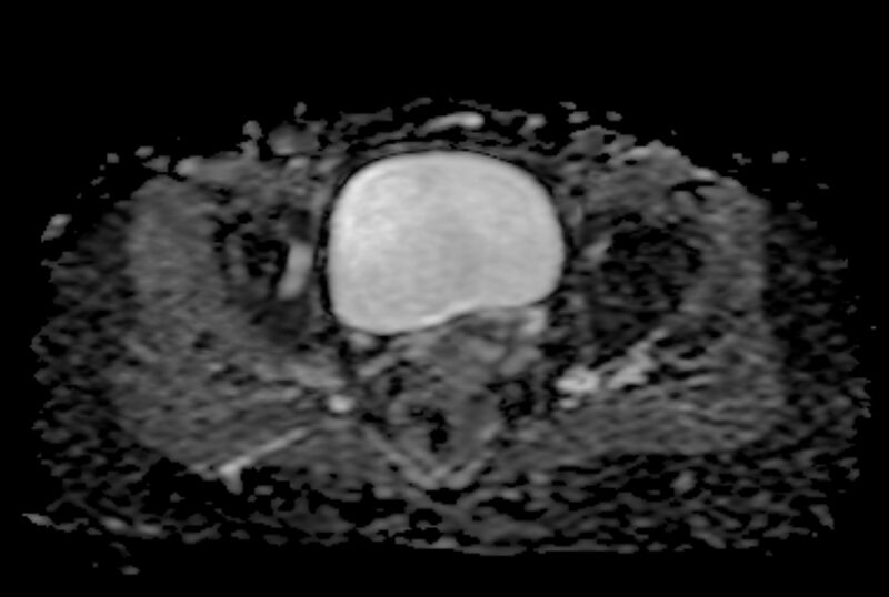 File:Adult granulosa cell tumor of the ovary (Radiopaedia 71581-81950 Axial ADC 19).jpg