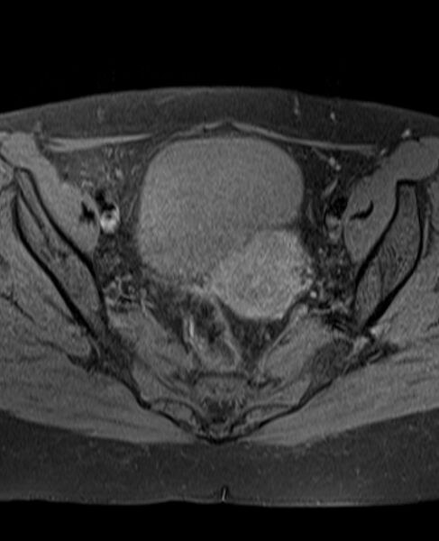 File:Adult granulosa cell tumor of the ovary (Radiopaedia 71581-81950 Axial T1 fat sat 14).jpg