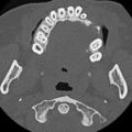 Ameloblastic fibro-odontoma (Radiopaedia 18843-18780 C 48).jpg