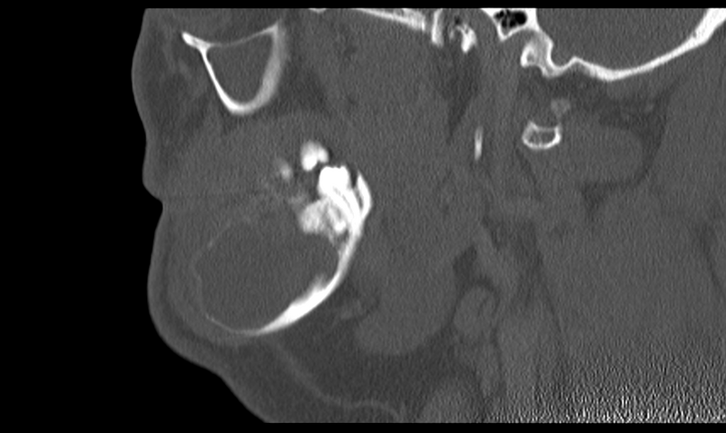 File:Ameloblastoma (Radiopaedia 33677-34806 Sagittal bone window 22).png