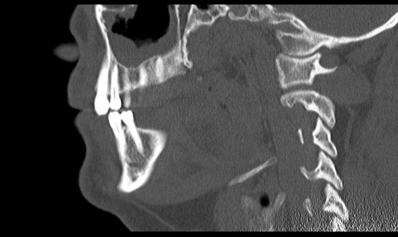File:Ameloblastoma (Radiopaedia 33677-34806 Sagittal bone window 39).png