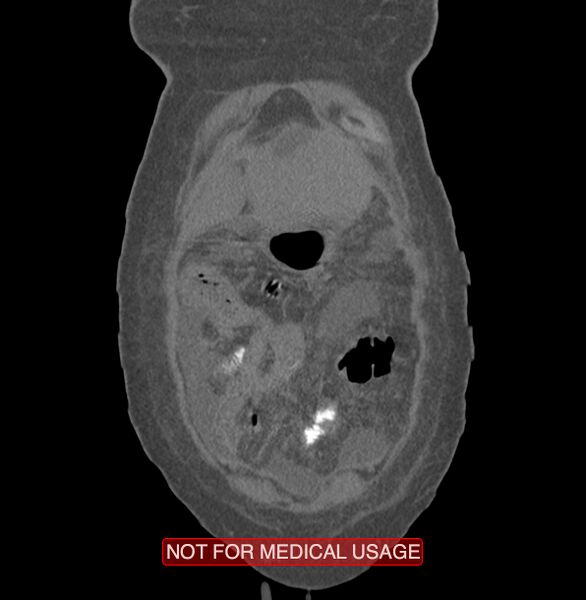 File:Amoebic enterocolitis with liver abscess (Radiopaedia 35100-36609 B 3).jpg