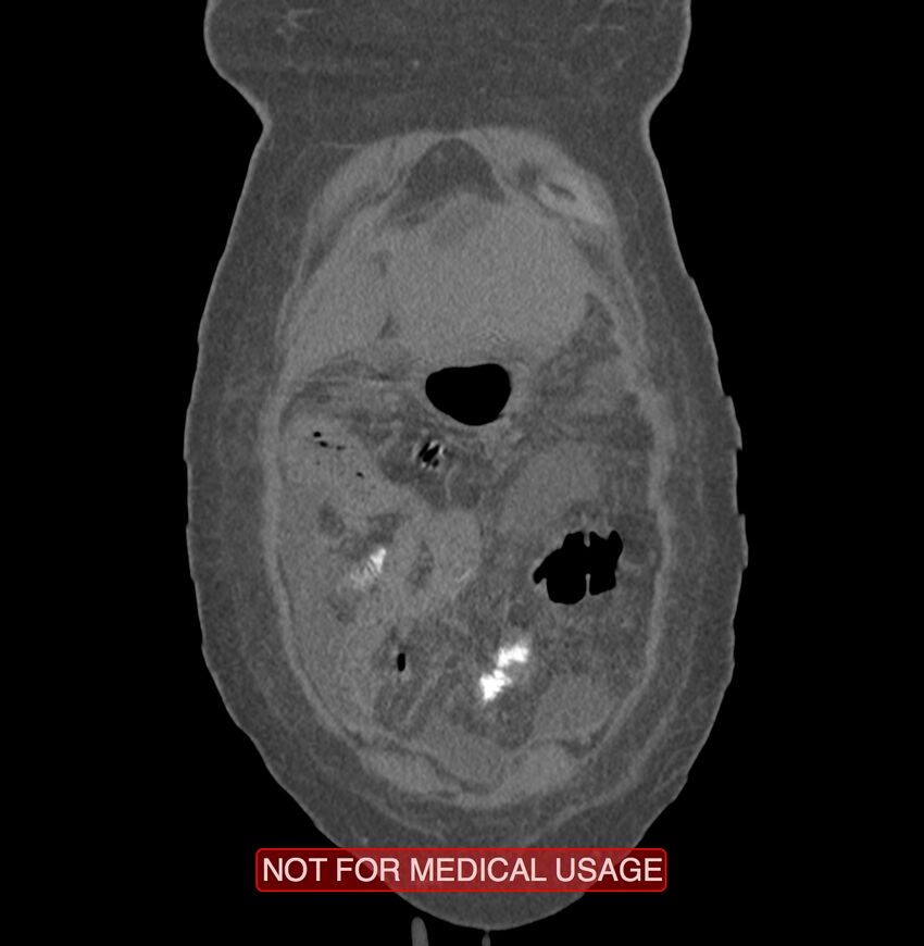 Amoebic enterocolitis with liver abscess (Radiopaedia 35100-36609 B 3).jpg