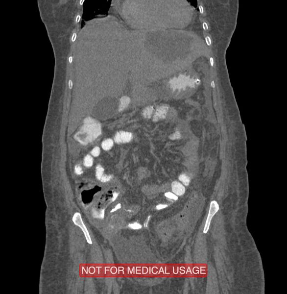File:Amoebic enterocolitis with liver abscess (Radiopaedia 35100-36609 B 61).jpg