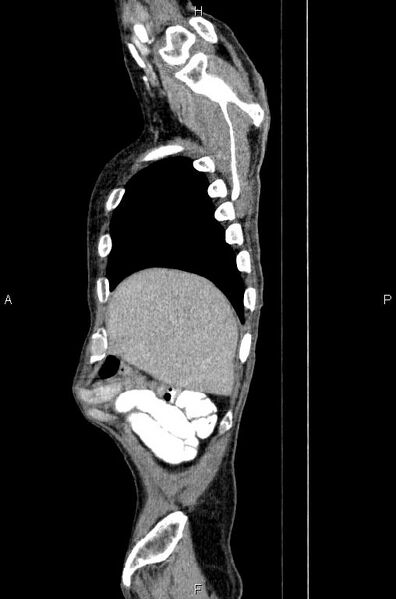 File:Ampullary adenocarcinoma (Radiopaedia 86093-102033 E 8).jpg