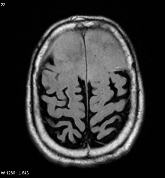 File:Anaplastic meningioma (Radiopaedia 5553-7290 Axial FLAIR 1).jpg