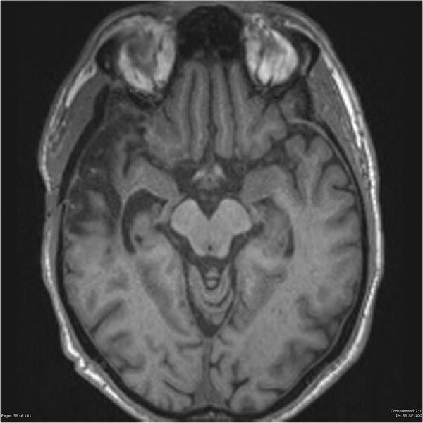 File:Anaplastic meningioma with recurrence (Radiopaedia 34452-35788 Axial T1 54).jpg