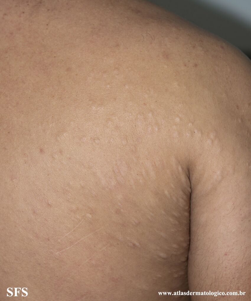 Anetoderma Jadassohn Pellizari (Dermatology Atlas 34).jpg