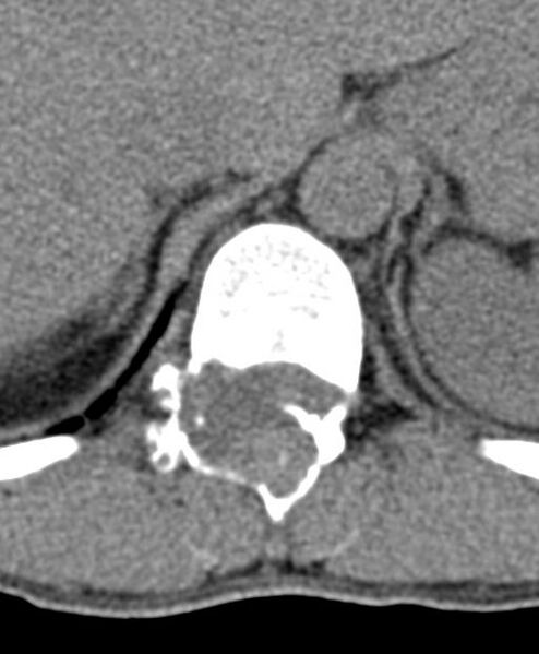 File:Aneurysmal bone cyst T11 (Radiopaedia 29294-29721 Axial non-contrast 44).jpg