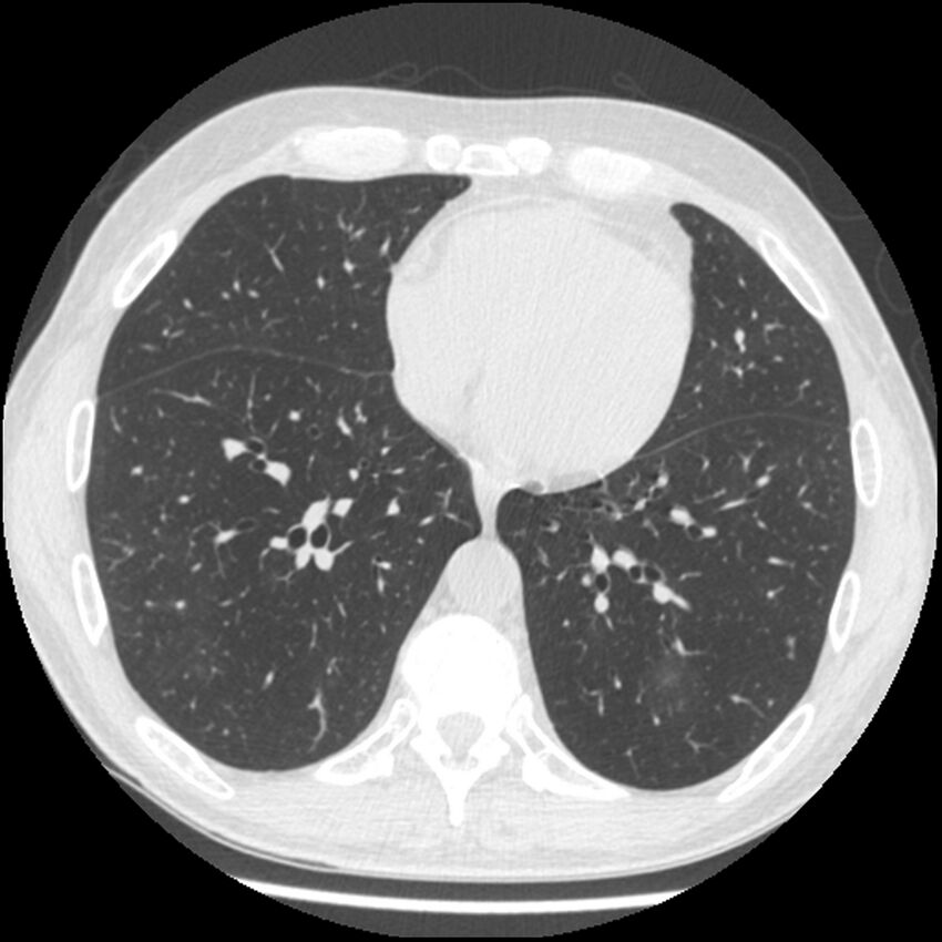 Angioinvasive aspergillosis (Radiopaedia 43957-47466 Axial lung window 46).jpg
