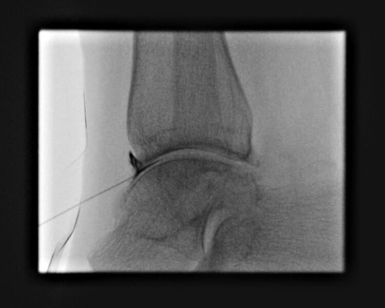 File:Ankle joint injection (fluoroscopic guided) (Radiopaedia 87288-103578 Lateral 11).jpg