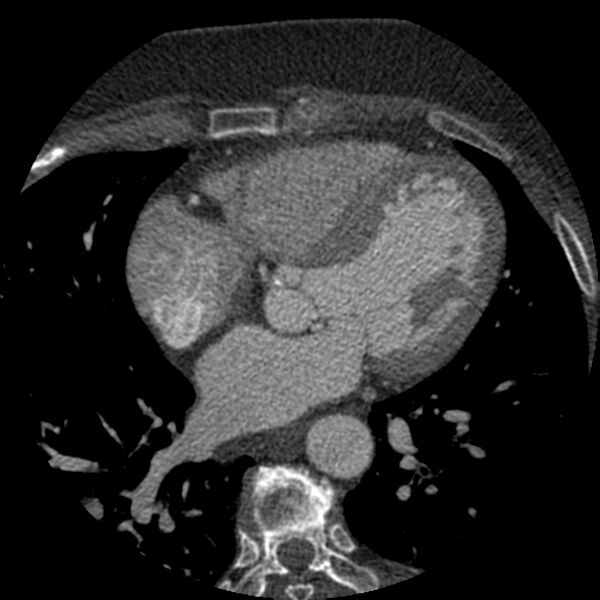 File:Anomalous origin of left circumflex artery from right coronary sinus (Radiopaedia 72563-83117 B 80).jpg