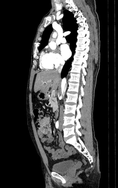 File:Aortic dissection - Stanford type A (Radiopaedia 83418-98500 B 25).jpg