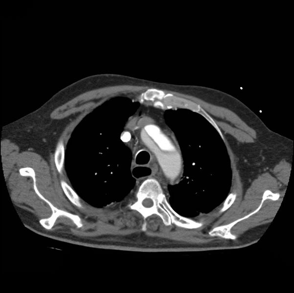 File:Aortic dissection with rupture into pericardium (Radiopaedia 12384-12647 A 15).jpg
