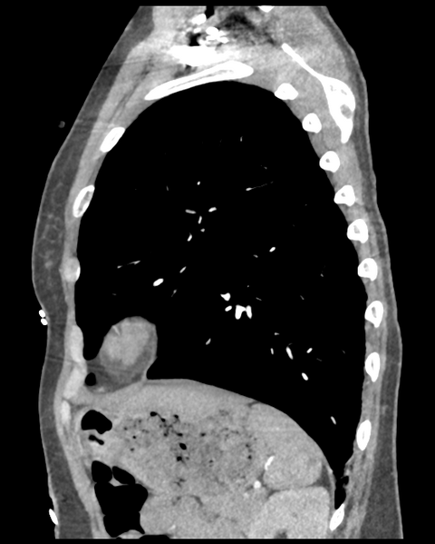 File:Aortic valve non-coronary cusp thrombus (Radiopaedia 55661-62189 D 14).png