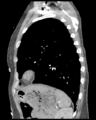 Aortic valve non-coronary cusp thrombus (Radiopaedia 55661-62189 D 14).png