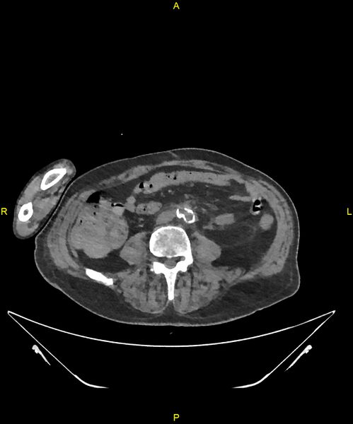File:Aortoenteric fistula (Radiopaedia 84308-99603 Axial non-contrast 221).jpg