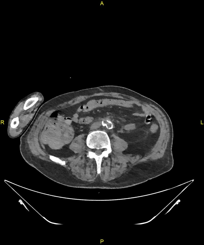 Aortoenteric fistula (Radiopaedia 84308-99603 Axial non-contrast 221).jpg