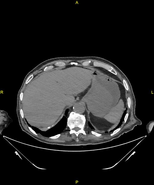 File:Aortoenteric fistula (Radiopaedia 84308-99603 Axial non-contrast 43).jpg