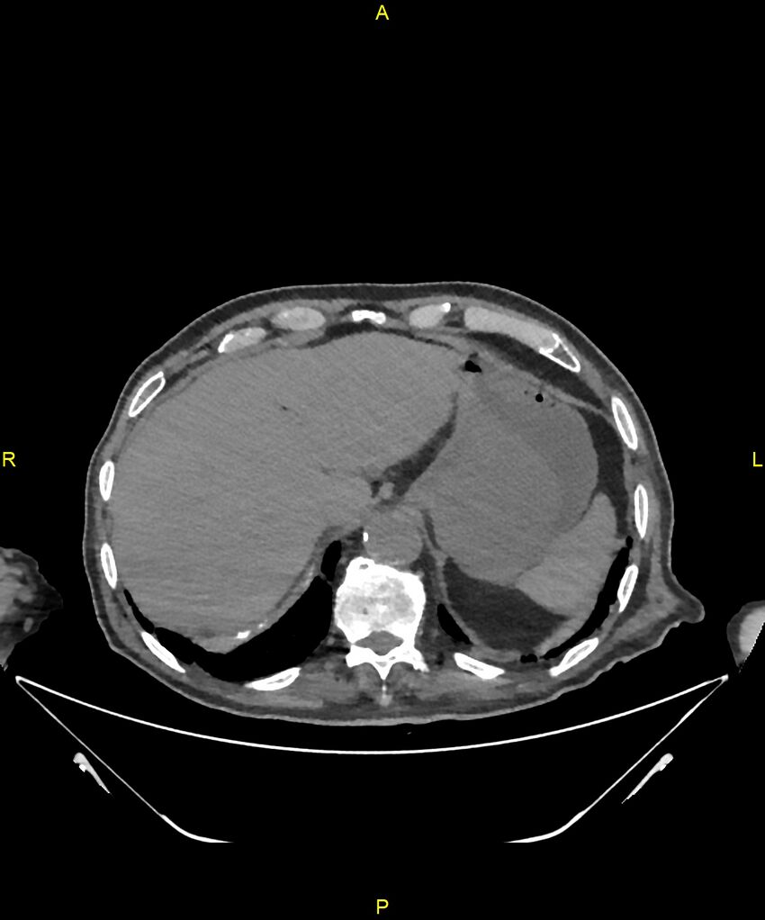 Aortoenteric fistula (Radiopaedia 84308-99603 Axial non-contrast 43).jpg