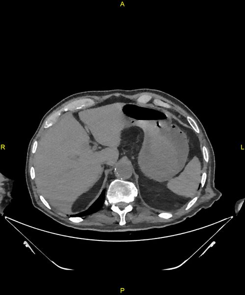 File:Aortoenteric fistula (Radiopaedia 84308-99603 Axial non-contrast 58).jpg