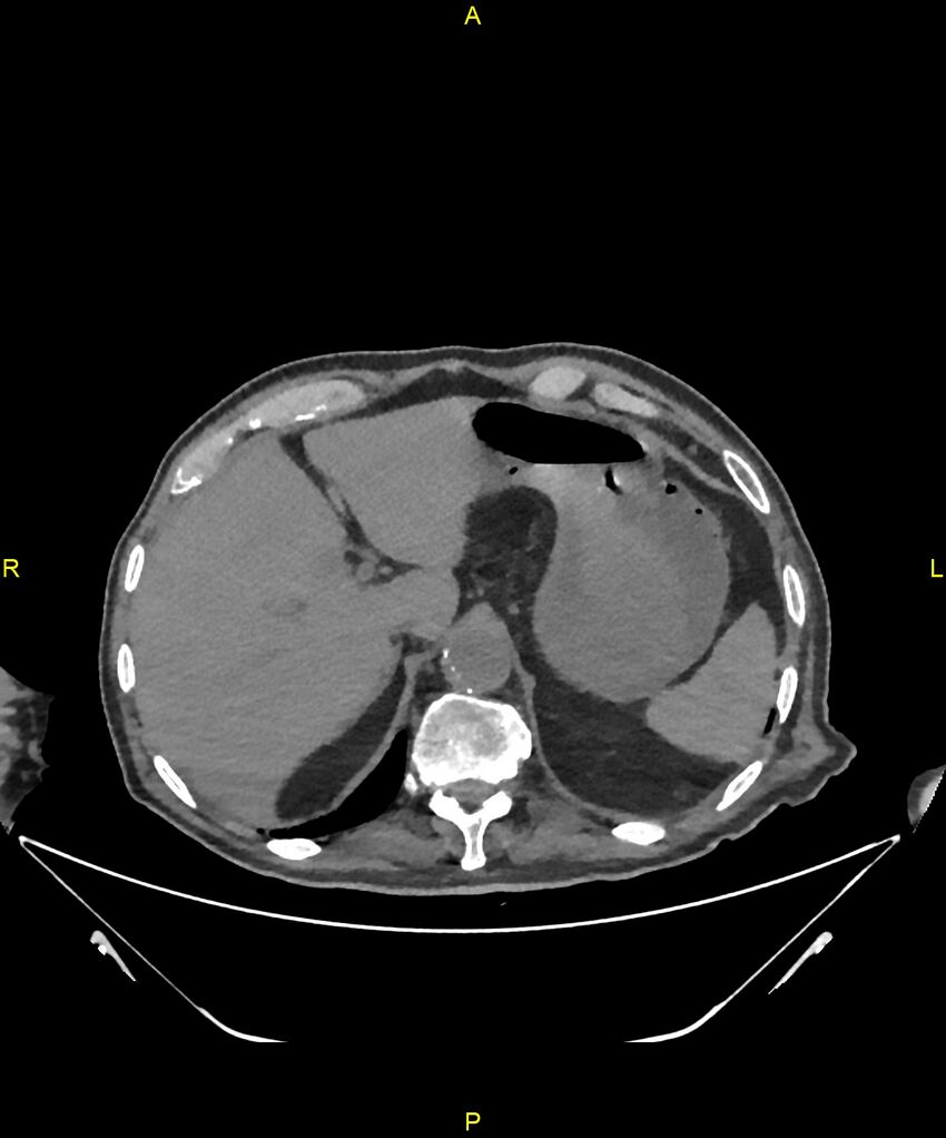 Aortoenteric fistula (Radiopaedia 84308-99603 Axial non-contrast 58).jpg