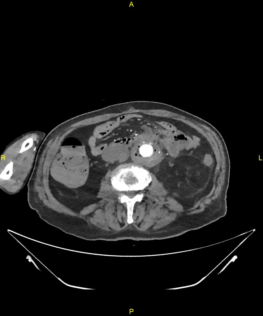 Aortoenteric fistula (Radiopaedia 84308-99603 B 193).jpg