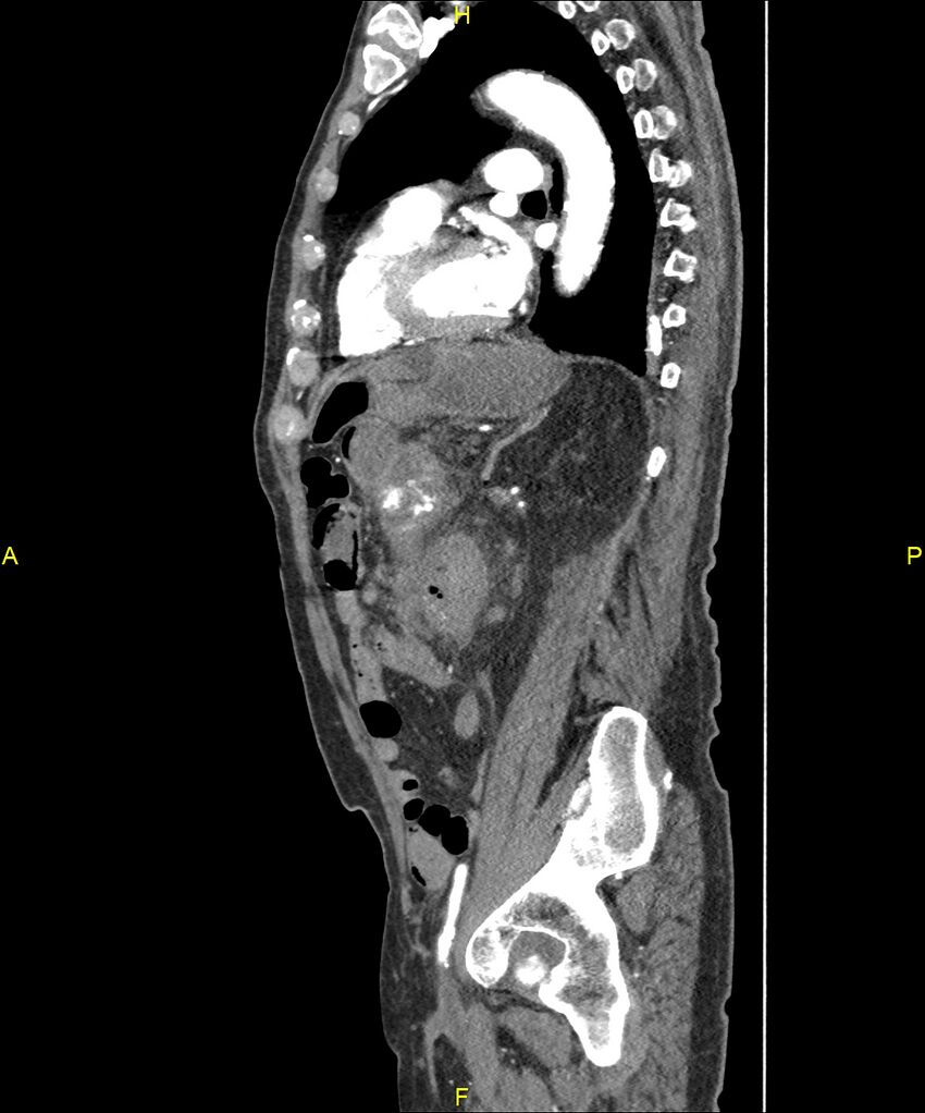 Aortoenteric fistula (Radiopaedia 84308-99603 C 223).jpg