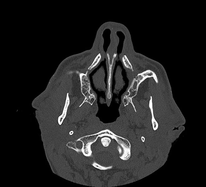 File:Aplastic maxillary sinuses (Radiopaedia 60030-67561 Axial non-contrast 18).jpg