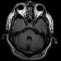 Arachnoid cyst - middle cranial fossa (Radiopaedia 9016-9775 Axial FLAIR 1).jpg