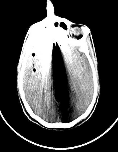 File:Arrow injury to the brain (Radiopaedia 72101-82607 Axial non-contrast 69).jpg