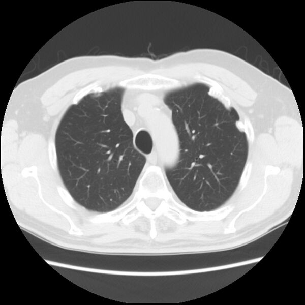 File:Asbestos-related pleural plaques (Radiopaedia 39069-41255 Axial lung window 18).jpg