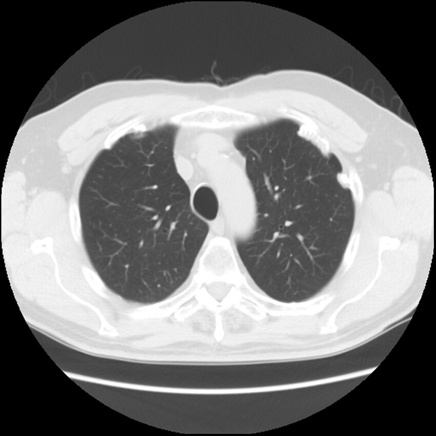 Asbestos-related pleural plaques (Radiopaedia 39069-41255 Axial lung window 18).jpg