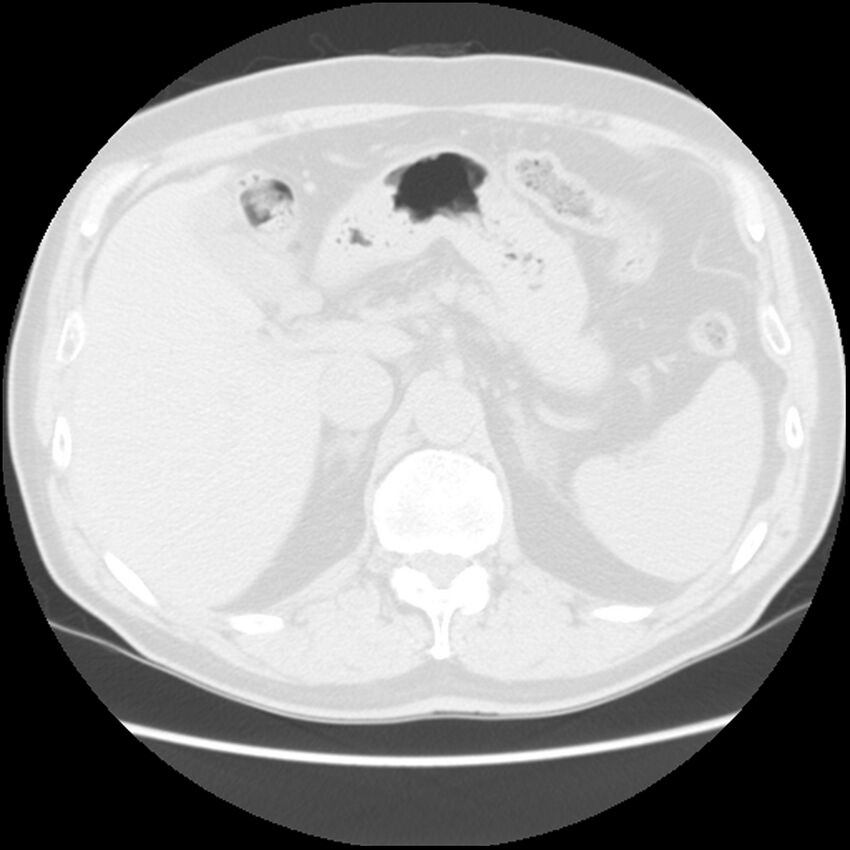 Asbestos-related pleural plaques (Radiopaedia 39069-41255 Axial lung window 71).jpg