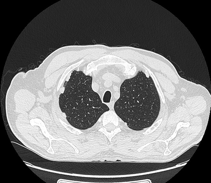 File:Asbestos pleural placques (Radiopaedia 57905-64872 Axial lung window 50).jpg