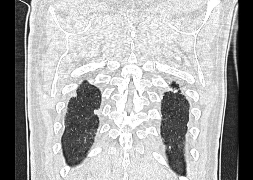 Asbestos pleural placques (Radiopaedia 57905-64872 Coronal lung window 269).jpg