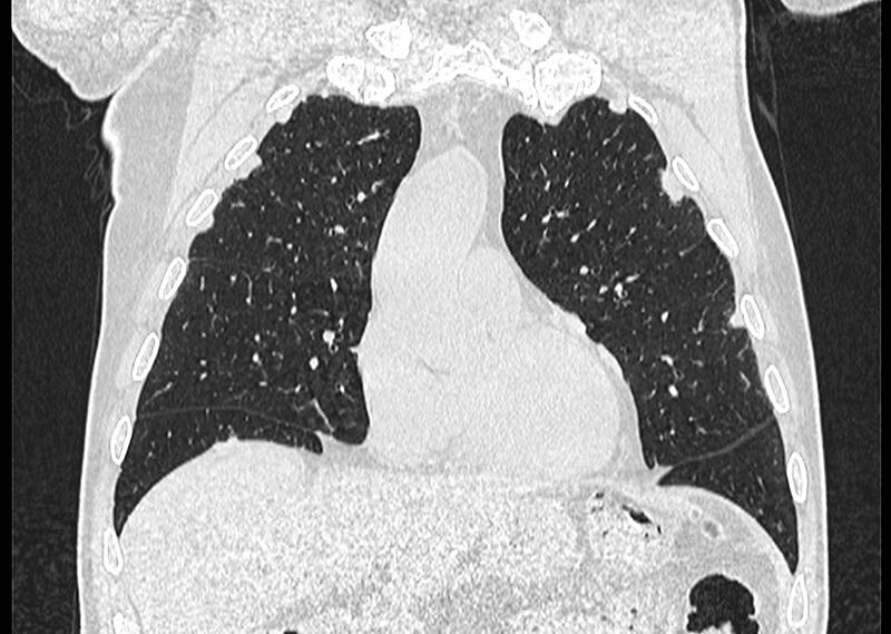 File:Asbestos pleural placques (Radiopaedia 57905-64872 Coronal lung window 91).jpg