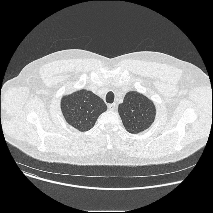 Asbestosis (Radiopaedia 45002-48961 Axial lung window 6).jpg