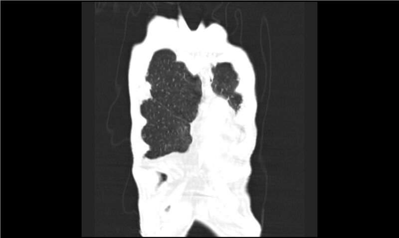 File:Aspergilloma (Radiopaedia 20788-20701 Coronal lung window 3).jpg