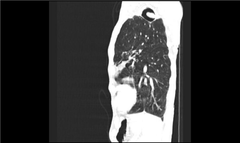 File:Aspergilloma (Radiopaedia 20788-20701 Sagittal lung window 4).jpg
