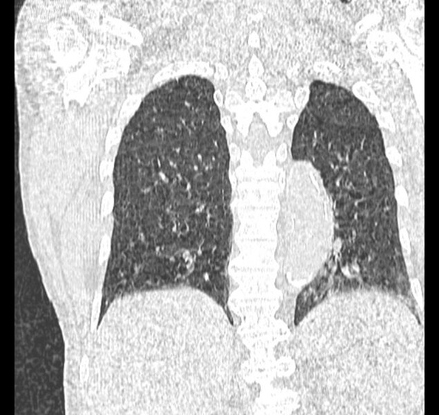 File:Aspergilloma (Radiopaedia 44592-48327 Coronal lung window 97).jpg