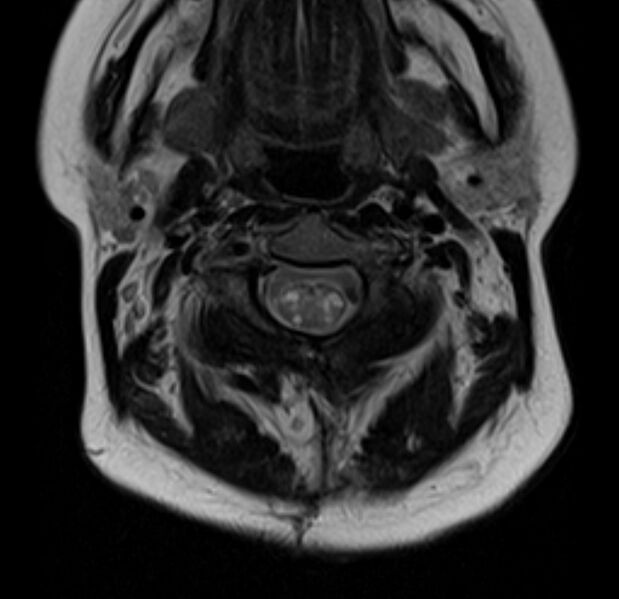 File:Astrocytoma - spinal cord (Radiopaedia 69769-79758 Axial T2 7).jpg