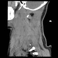 Atlanto-occipital dislocation (Radiopaedia 44648-48412 A 3).jpg