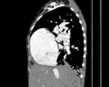 Atrial septal defect complicated by Eisenmenger syndrome (Radiopaedia 53707-59768 Sagittal C+ CTPA 8).jpg