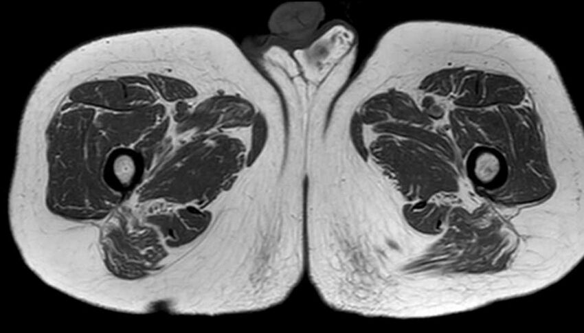 Atypical lipomatous tumor - thigh (Radiopaedia 68975-78734 Axial T1 71).jpg