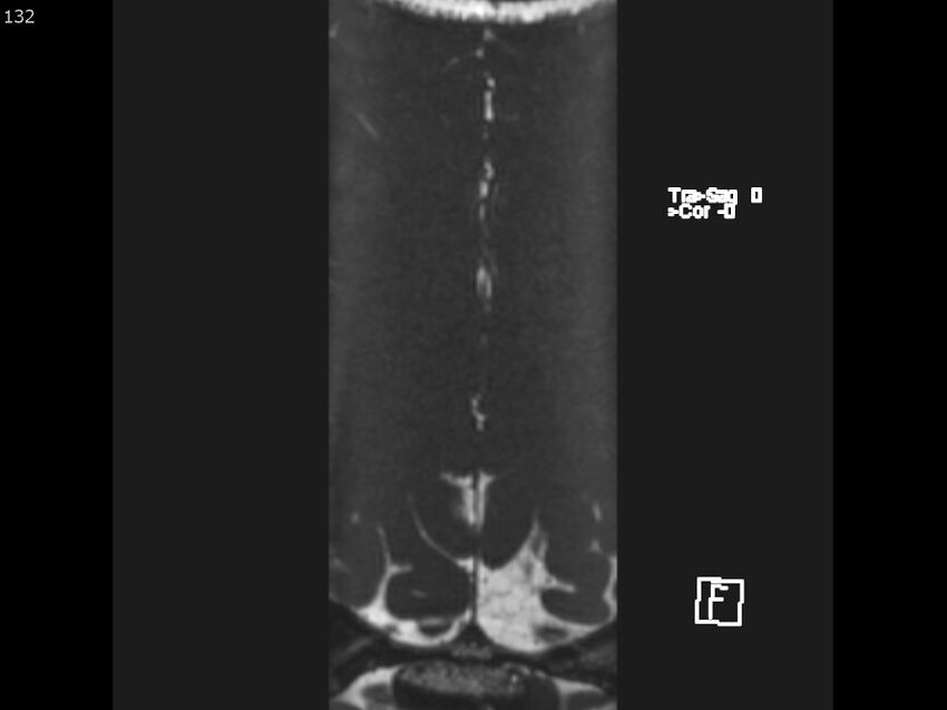 Atypical meningioma - intraosseous (Radiopaedia 64915-74572 Axial CISS 132).jpg